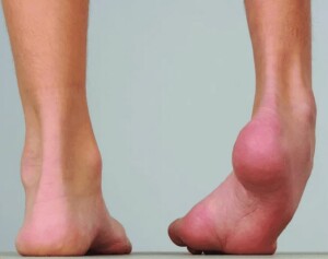 Cerebral Palsy-Drop Foot